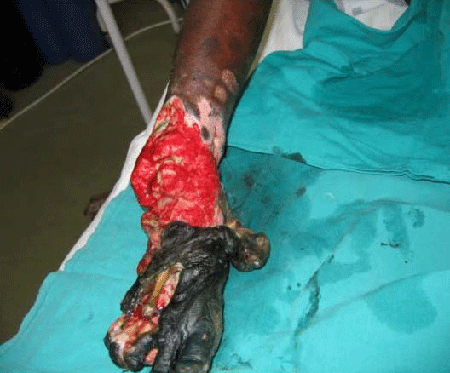 Spitting cobra bite