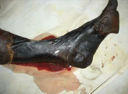 Tissue necrosis from a carpet viper bite