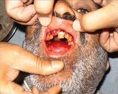 Gingival bleeding