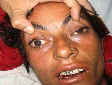 Patient showing lateralising neurological signs